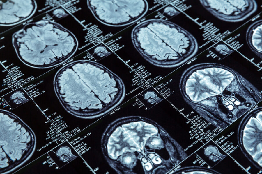 Ilustración médica de tumores cerebrales con neurocirujano explicando diagnóstico a familia